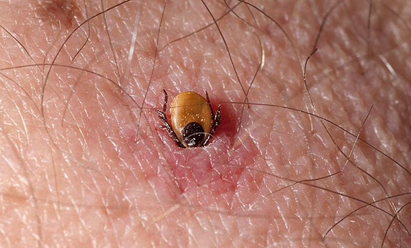 La tique s'est implantée dans la peau d'une personne. La tique s'est implantée dans la peau d'une personne.