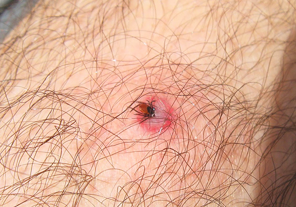 Ces parasites sont capables de transmettre les agents pathogènes de maladies très dangereuses pour l'homme... Ces parasites sont capables de transmettre les agents pathogènes de maladies très dangereuses pour l'homme...