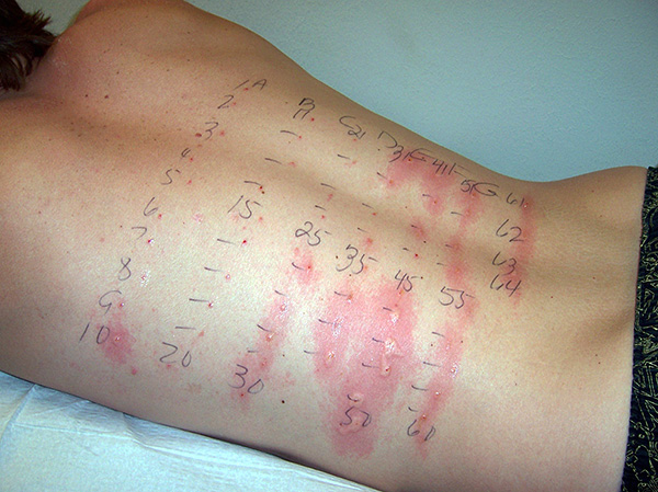 Ces tests permettent de déterminer précisément quelles substances sont allergènes pour l'organisme concerné. Ces tests permettent de déterminer précisément quelles substances sont allergènes pour l'organisme concerné.