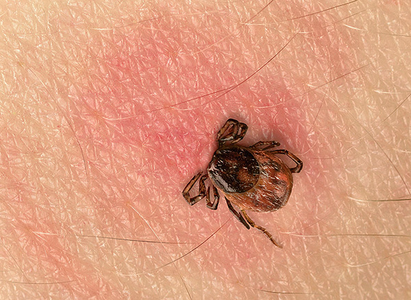 Une injection effectuée en urgence permet avec une forte probabilité de se protéger contre l'ET, même si une personne a été mordue par plusieurs tiques infectées à la fois. Une injection effectuée en urgence permet avec une forte probabilité de se protéger contre l'ET, même si une personne a été mordue par plusieurs tiques infectées à la fois.