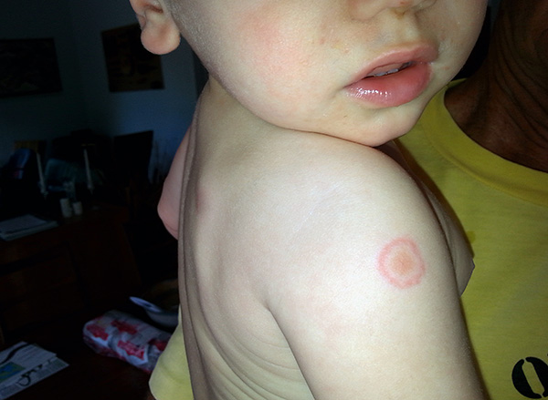 Sur la photo, on voit la marque d'une piqûre de tique sur le bras d'un enfant. Sur la photo, on voit la marque d'une piqûre de tique sur le bras d'un enfant.