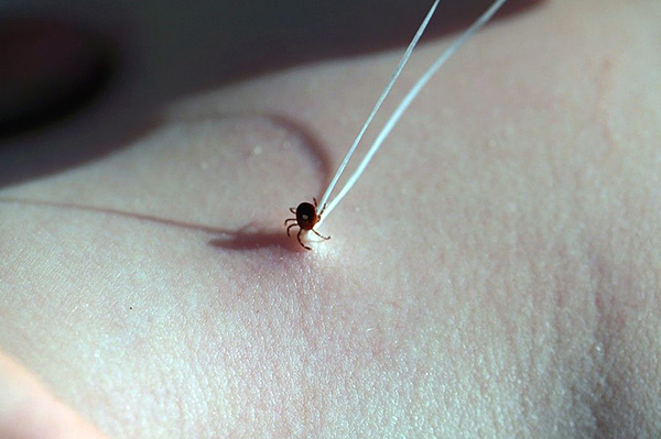 Exemple de retrait d'une tique à l'aide d'un fil Exemple de retrait d'une tique à l'aide d'un fil