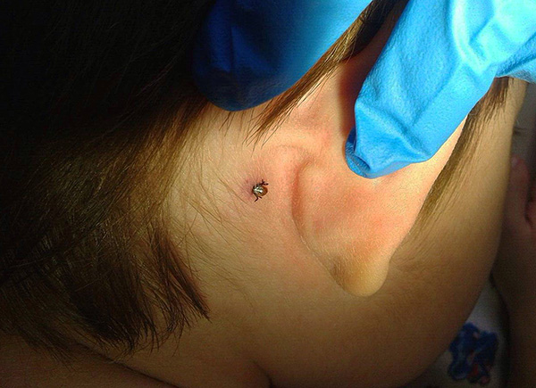 Une tique s'est fixée derrière l'oreille d'un enfant.