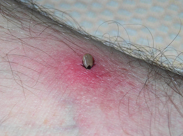Plus la tique reste fixée sur le corps, plus elle injecte de salive infectée sous la peau.