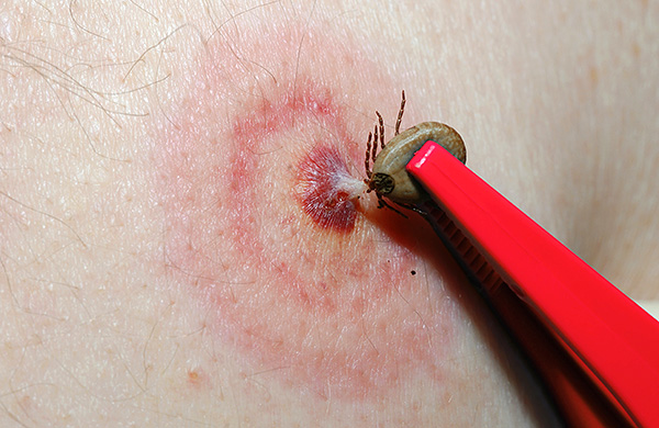 Voyons à quoi ressemblent les piqûres de tiques normalement et quand on peut parler d'une infection dangereuse avérée... Voyons à quoi ressemblent les piqûres de tiques normalement et quand on peut parler d'une infection dangereuse avérée...
