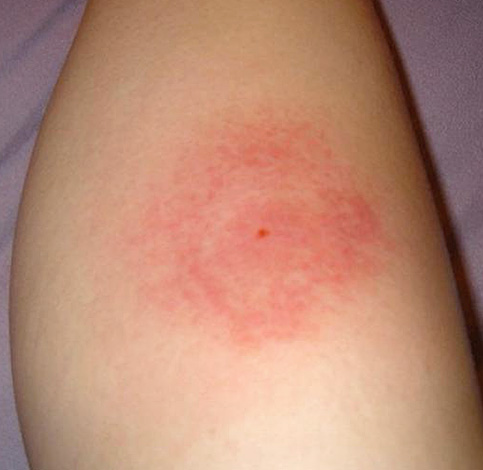 Piqûre d'un moucheron hématophage Piqûre d'un moucheron hématophage