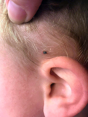 Le site de fixation préféré du parasite chez les enfants est près des oreilles. Le site de fixation préféré du parasite chez les enfants est près des oreilles.