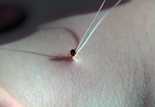 Le parasite accroché peut être retiré à l'aide d'un simple fil. Le parasite accroché peut être retiré à l'aide d'un simple fil.