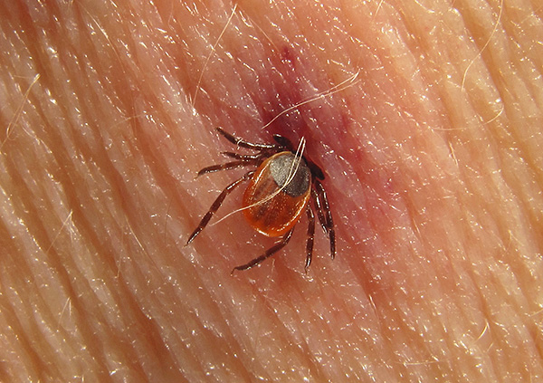 L'encéphalite à tiques et la borréliose de Lyme conduisent souvent à un handicap pour le patient.