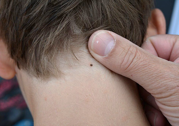Une tique s'est fixée au cou d'un enfant Une tique s'est fixée au cou d'un enfant