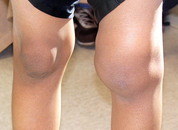 Conséquences de l'arthrite développée à cause de la borréliose de Lyme Conséquences de l'arthrite développée à cause de la borréliose de Lyme