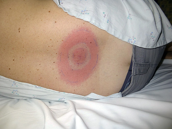 L'érythème annulaire est un signe caractéristique d'infection par la borréliose après une piqûre de tique. L'érythème annulaire est un signe caractéristique d'infection par la borréliose après une piqûre de tique.