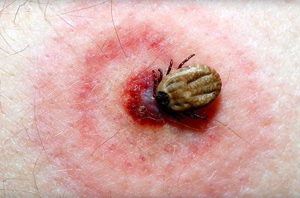 Anneau rouge sur la peau après la morsure d'une tique porteuse de la borréliose