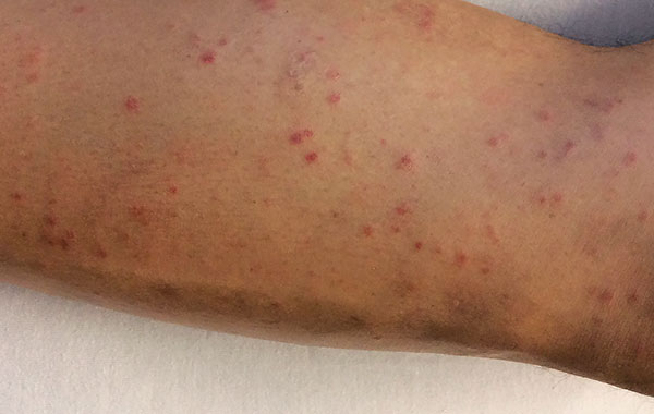 Éruption cutanée lors de la fièvre boutonneuse méditerranéenne